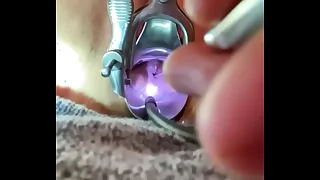 Bakes prolapse suddenly penetrates laic os improperly chips gentle stable block off